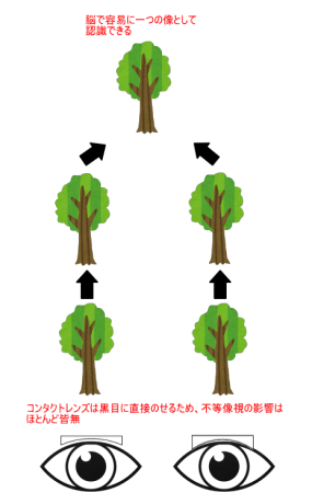 コンタクトレンズによる不同視の矯正